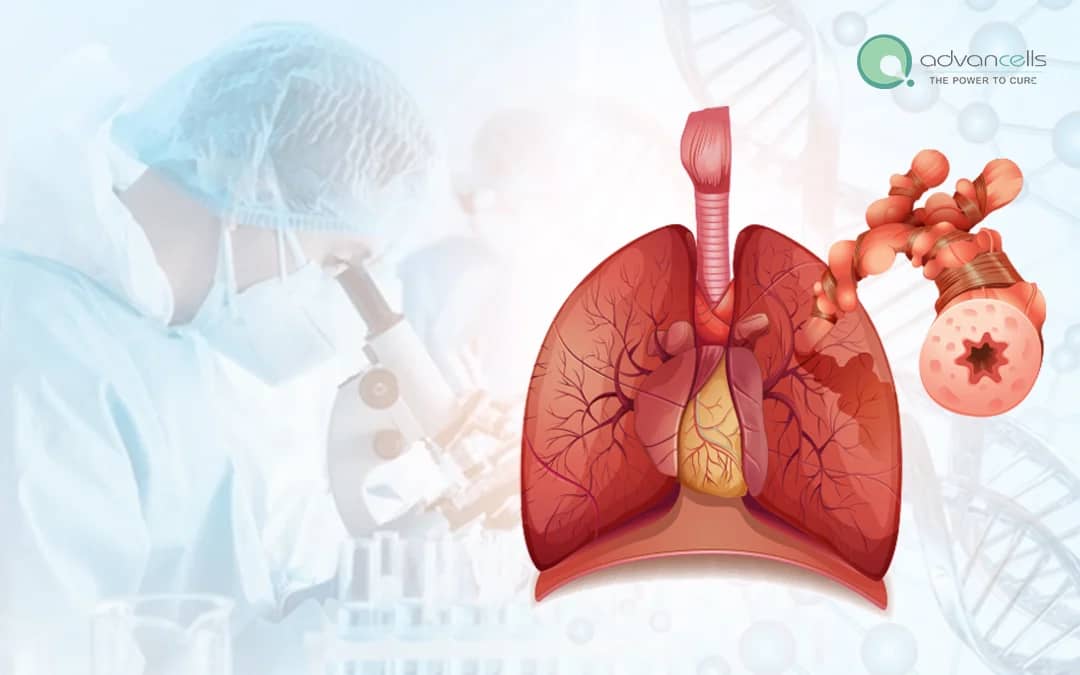 Stem Cell Therapy for COPD: A Promising Frontier