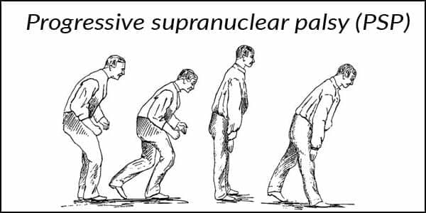 Progressive Supranuclear Palsy (PSP): All You Need To Know From Symptoms To Treatments