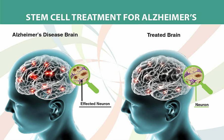 Alzheimer's stem cell treatment